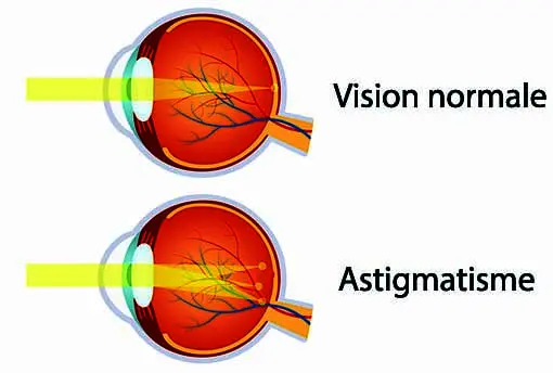 astigmatisme