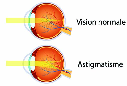 astigmatisme